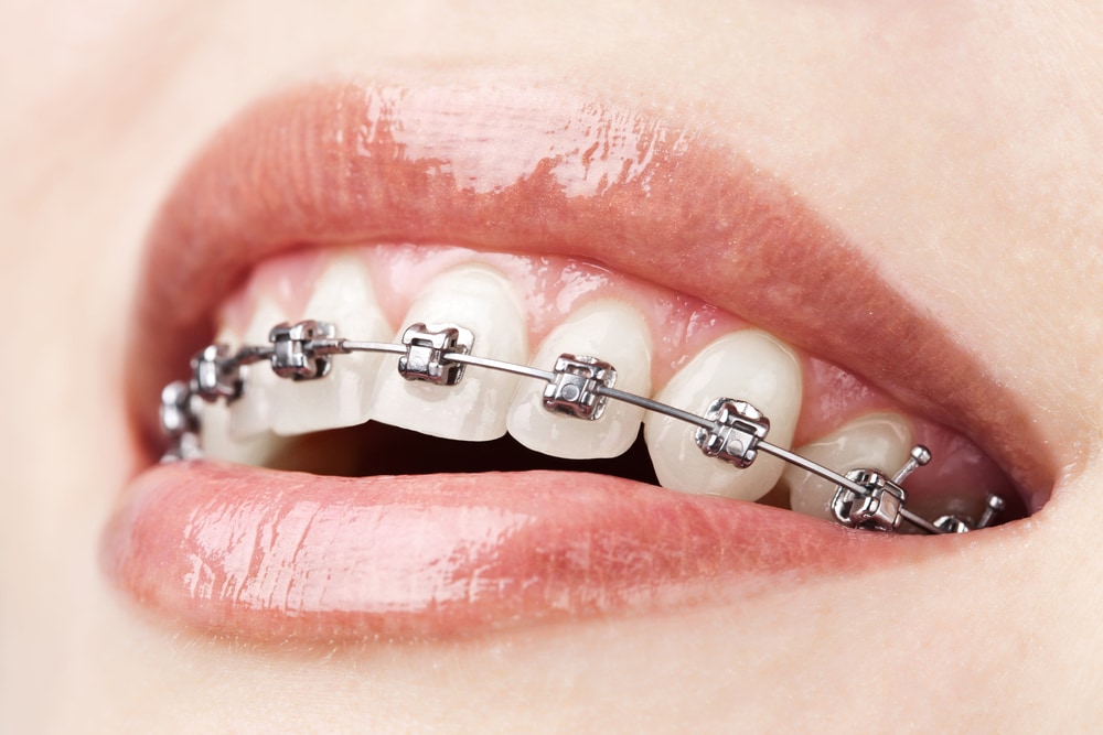 What Braces Can Correct and What They Can't
