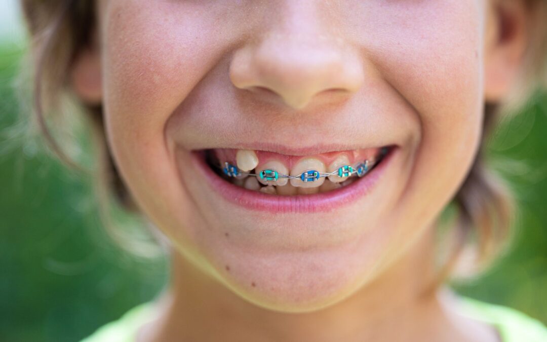 How Long Will Your Child Need to Wear Braces
