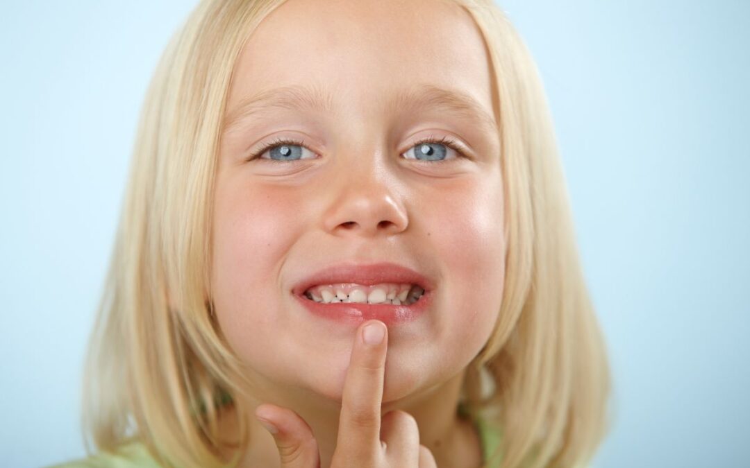 Young girl pointing to a chipped tooth, illustrating common childhood dental injuries and the need for prompt dental care.